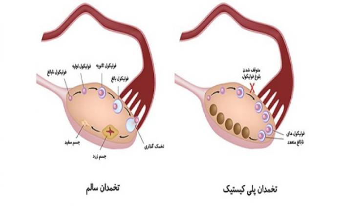 آیا با وجود کیست و تنبلی تخمدان میتوان باردار شد؟