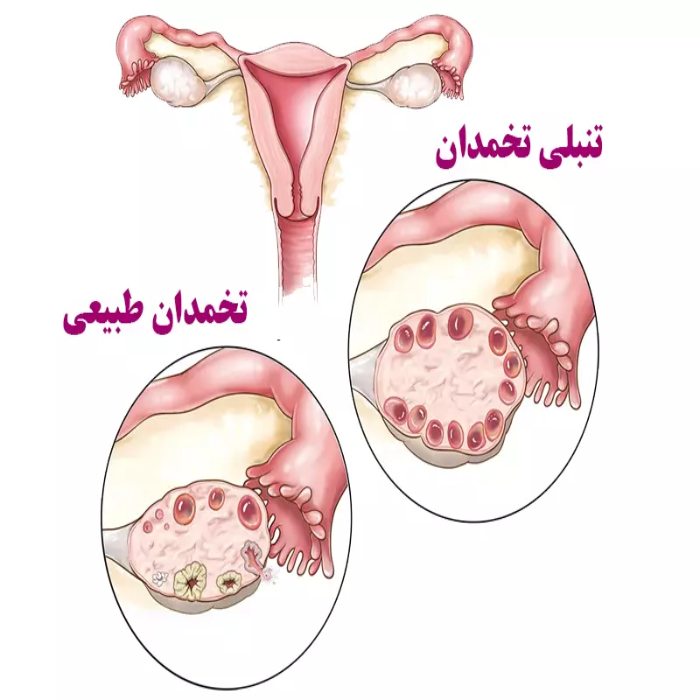 Lazy ovary vs normal ovary2