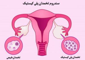 تنبلی تخمدان درمان نشود چه می شود 1